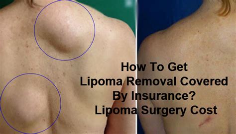 Enroll by Dec. . Lipoma removal covered by insurance blue cross blue shield